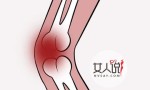 滑膜炎是什么，为什么会得滑膜炎